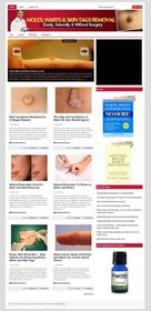Moles, Warts and Skin Removal PLR Niche Blog small